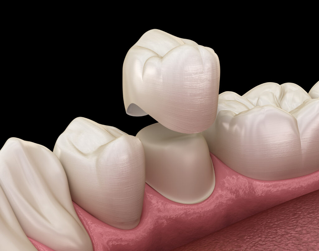 A close-up view of a custom dental crown restoration