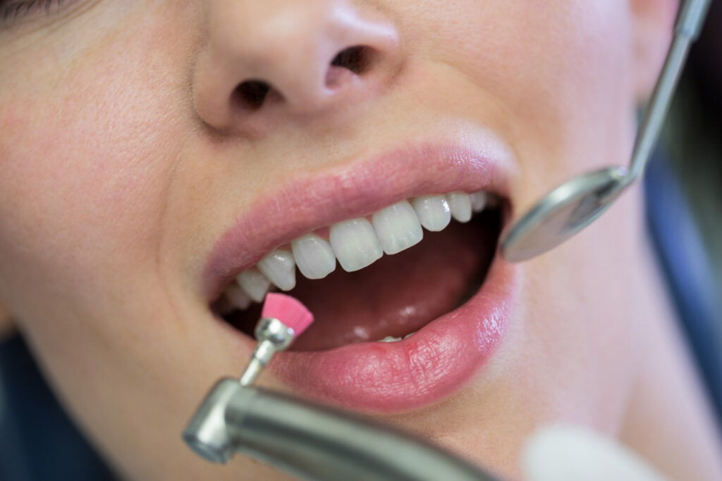 veneers
