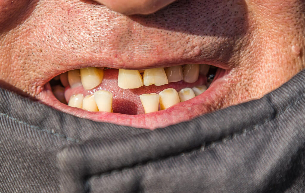 missing teeth